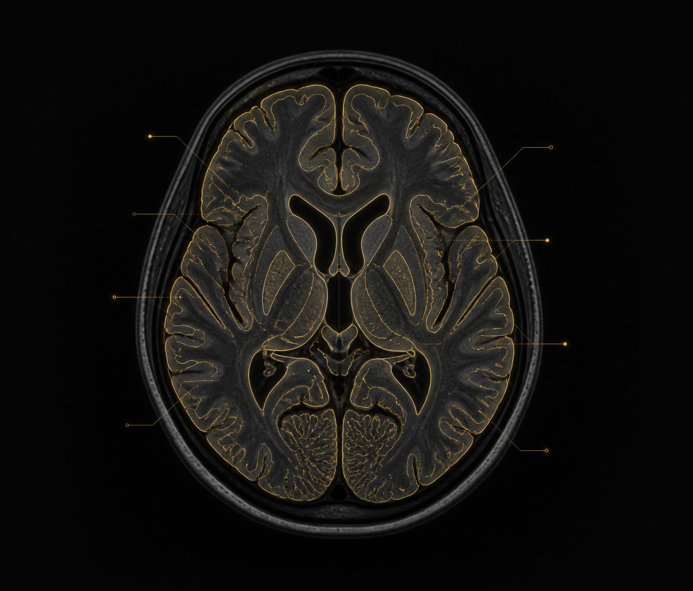 Brain MRI annotated with gold segmentation contours by an Amplitude Healthcare radiologist